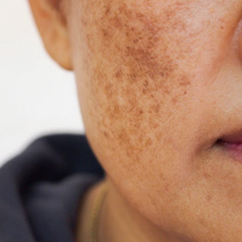 Laser Treatment for Acne Scars in Thane | Dr Aditi Bhagat